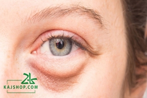 درمان پف زیر چشم (24 روش که از آن بی خبرید!)