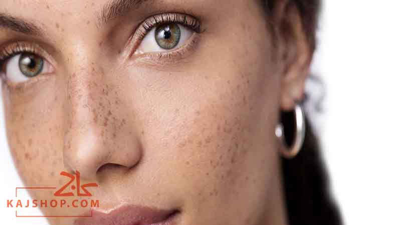 پیشگیری از لکه های پوستی با ضد آفتاب