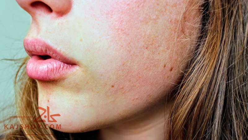 علت خشکی پوست صورت و نشانه های آن