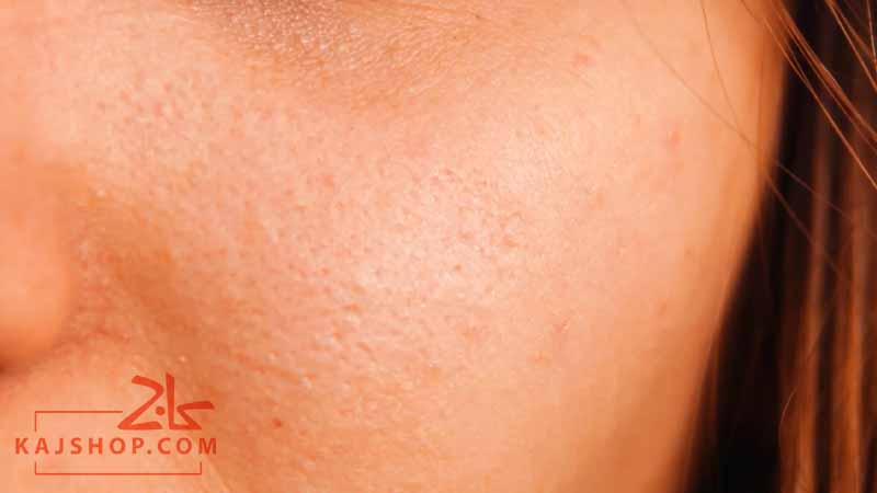 درمان خانگی برای کاهش چربی پوست